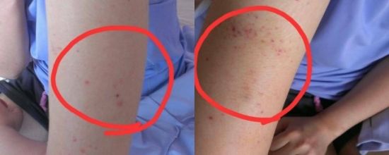 有像痣一样的小红点不痛不痒,身上长小红点像小白点