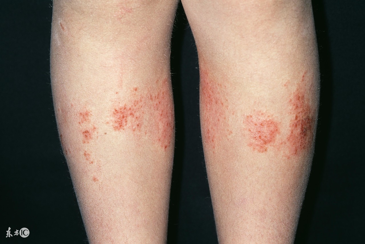 温盐水治疗湿疹,用热水泡脚可以治疗湿疹吗