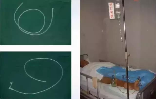 如何促进感染创面的愈合,创面感染原因