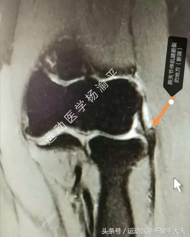 做完小针刀打封闭,做了一次小针刀怎么补救