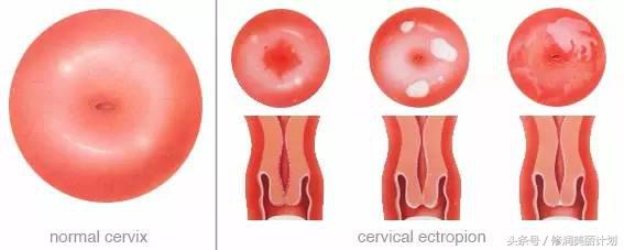 妇科知识宫颈糜烂是怎么引起的,关于妇科宫颈方面的知识