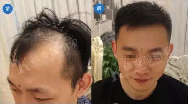 怎么样的发际线为圆形,怎么样的发际线适合长发