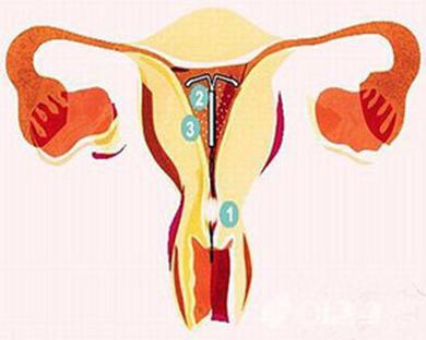 上环很容易累吗,上环过程受罪吗