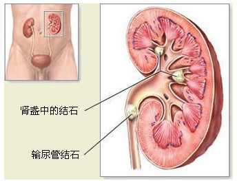 肾结石疼痛缓解后还疼,女肾结石疼痛怎么缓解