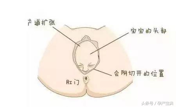 顺产侧切缝线怎么恢复,顺产侧切怎么有利于伤口恢复