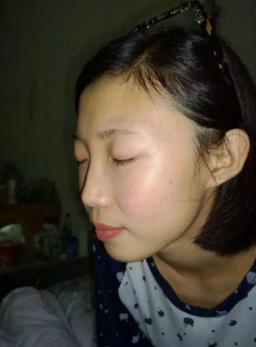 妈妈为女儿消脸上疤,妈妈为了孩子不容易