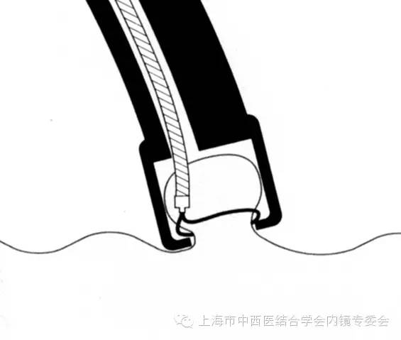 内镜套扎是什么,内镜套扎器械