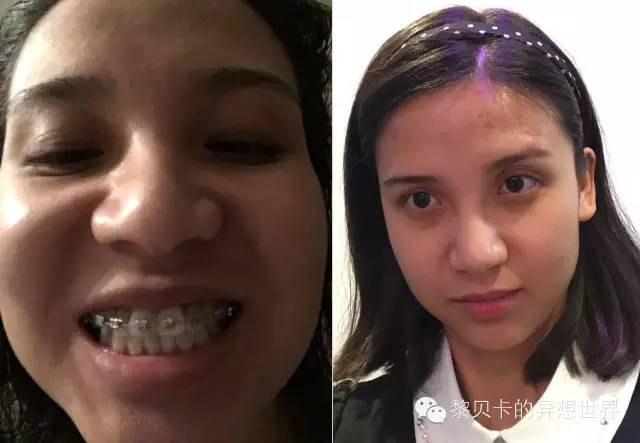 她们说||那些年整牙吞下的血和泪,终于换来最开怀的大笑