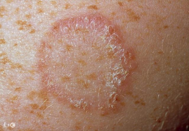 癣的种类分别怎么治疗,癣的诊断