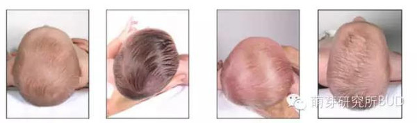 宝宝偏头莫担忧预防纠正有妙招,宝宝偏头的最佳治疗方法