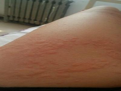 3岁宝宝过敏性荨麻疹吃什么药,3岁宝宝荨麻疹反复发作怎么办