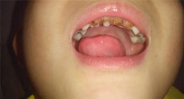 3岁的宝宝一口乳牙全烂光，都怪妈妈睡前给她喝这个