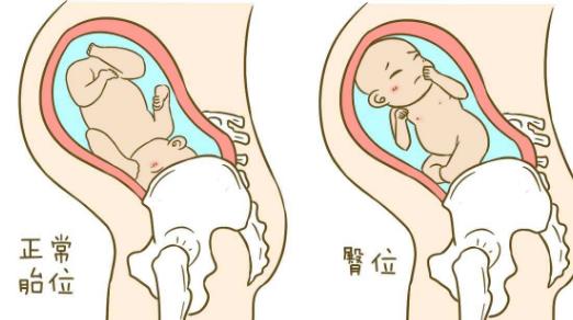 孕妈检查胎位不正,孕中期怎么纠正胎位