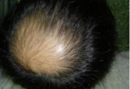 情绪不好出现皮肤病,情绪不稳定得皮肤病