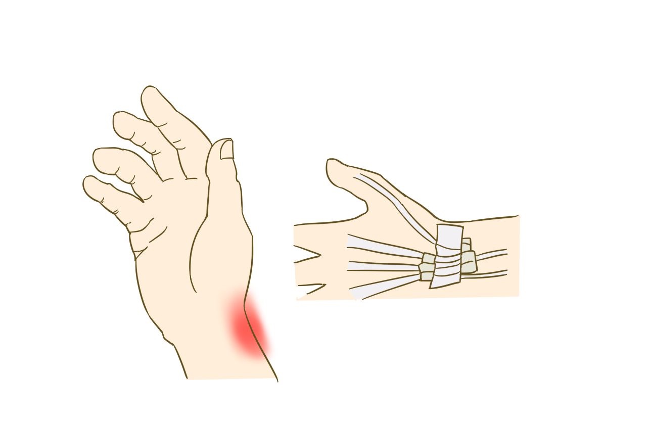 针刺一个穴治疗屈指肌腱腱鞘炎病例探讨