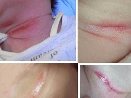 夏天宝宝的脖子很容易淹，千万不要再擦干粉，这几个小妙招很管用