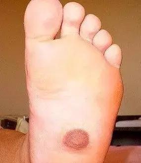 腋下两团赘肉是副乳吗,怎么消除副乳腋下肉