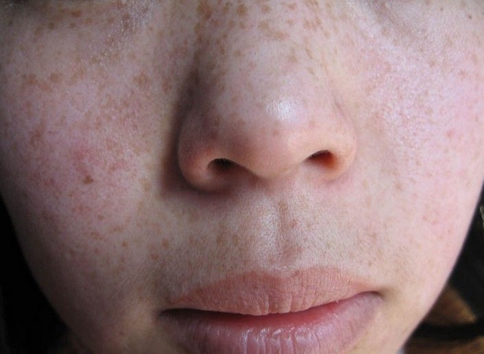 黄斑褐斑雀斑怎么生成的,雀斑黄褐斑色素暗沉怎么治