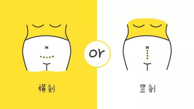 顺产和剖腹产你怎么选,如何选择顺产和剖腹产