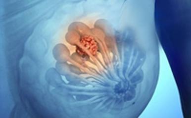 乳房刺痛减轻是乳腺增生缓解了吗,乳房胀痛是乳腺增生还是乳腺结节