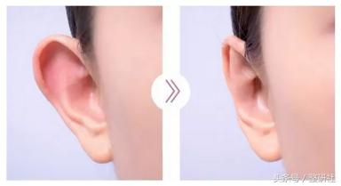 完美耳部成形术功能外观与福气集一身