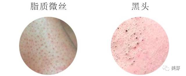 粉刺黑头去除最快方法,黑头虫怎么去除最快方法