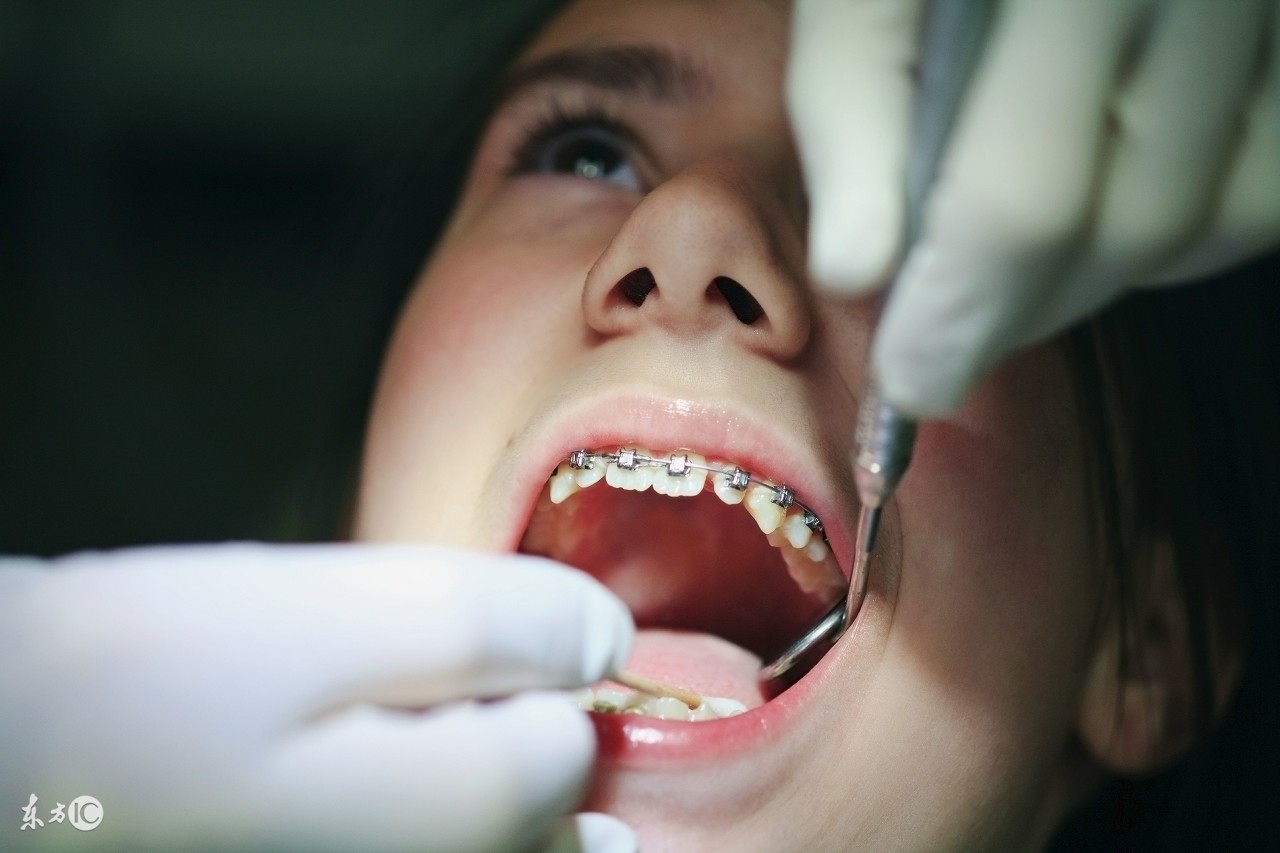 再也不做钢牙妹｜3D打印隐形牙套—上海正雅齿科获5000万B轮投资