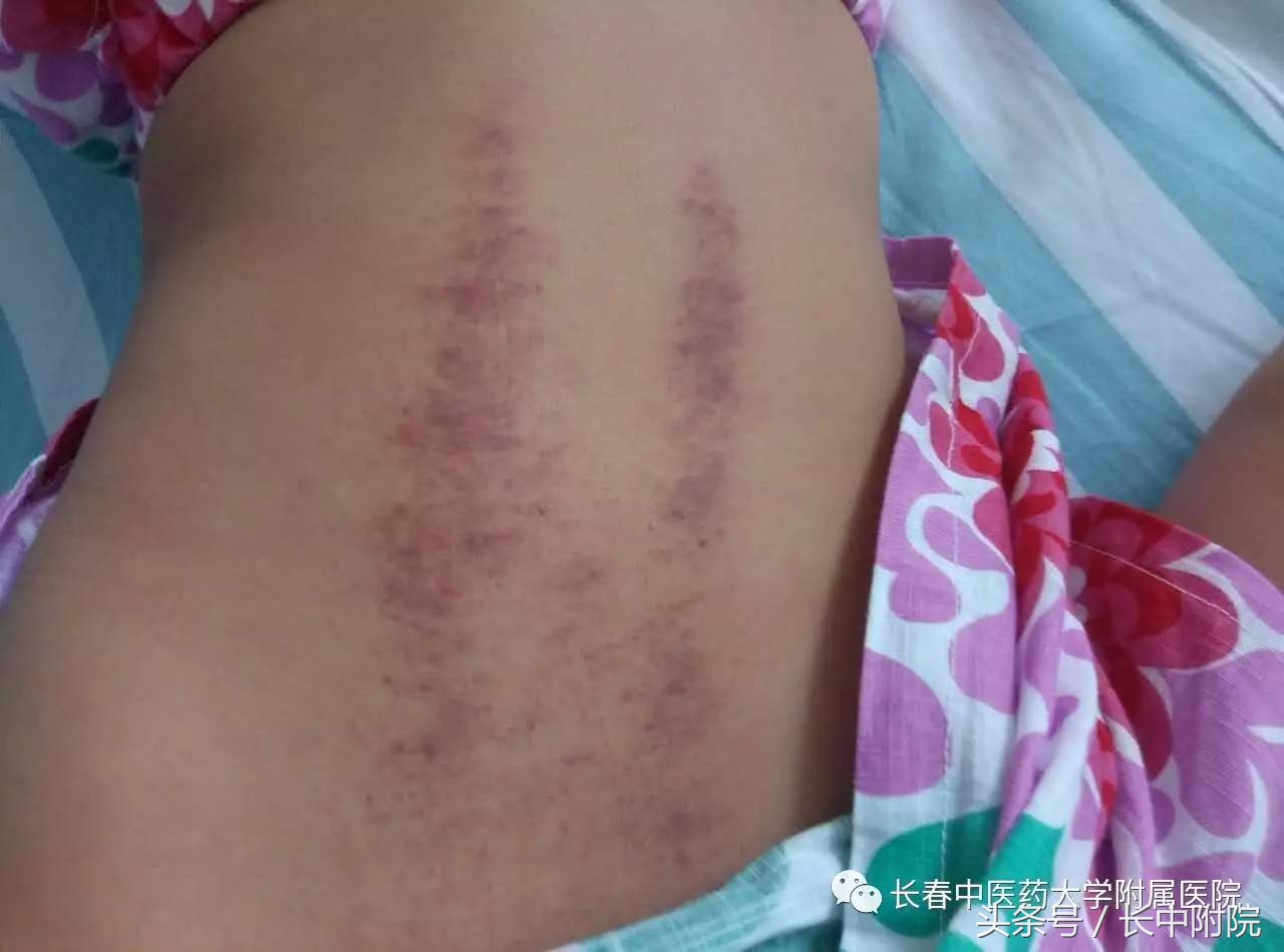 小儿疱疹性咽峡炎用什么中药贴敷,儿科孙丽萍