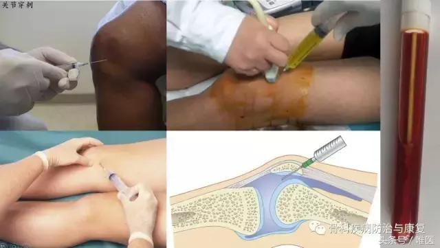 如何消除关节炎的肿胀积液,怎么确诊滑膜炎和膝关节炎