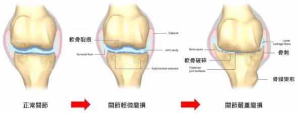 骨关节炎最新诊疗指南,骨关节前十医院