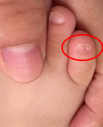 小脚趾指甲分两半的历史,小脚趾指甲分两半的历史故事