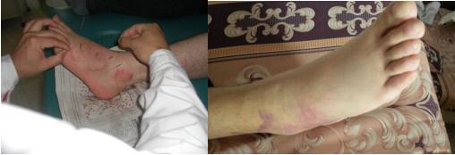 有过扭伤经历的人千万不能乱治我是被折磨惨了