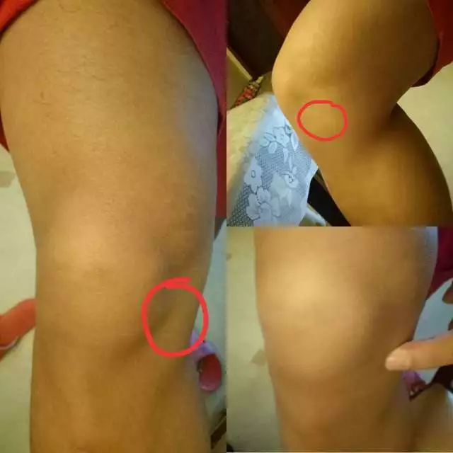 网球肘详细讲解,如何发力避免网球肘