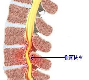 胸椎管狭窄中医最佳治疗方法,胸椎管狭窄症的规范诊疗技术