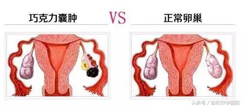 你了解卵巢巧克力囊肿吗？该如何预防和治疗呢？