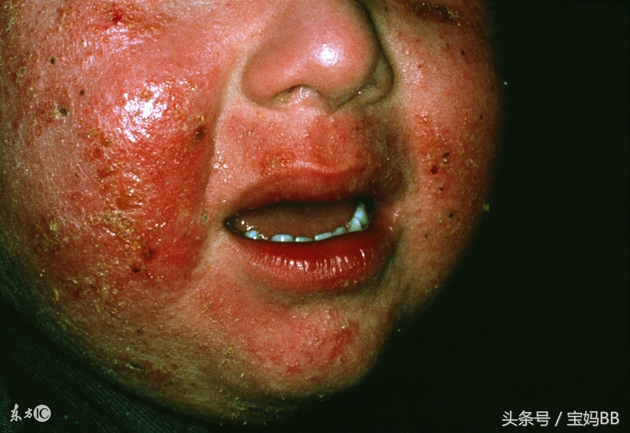 奶粉中什么促进毛发生长预防湿疹,新生儿热疹和湿疹的预防与护理