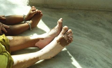 用了偏方白斑越治越严重？其实想要疾病痊愈，遵从四点就够了