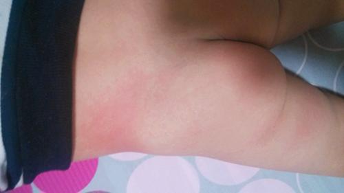 家长说孩子身上有痱子,宝宝身体上有痱子