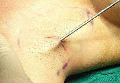 狐臭手术2021价目表,做狐臭手术需要多少费用