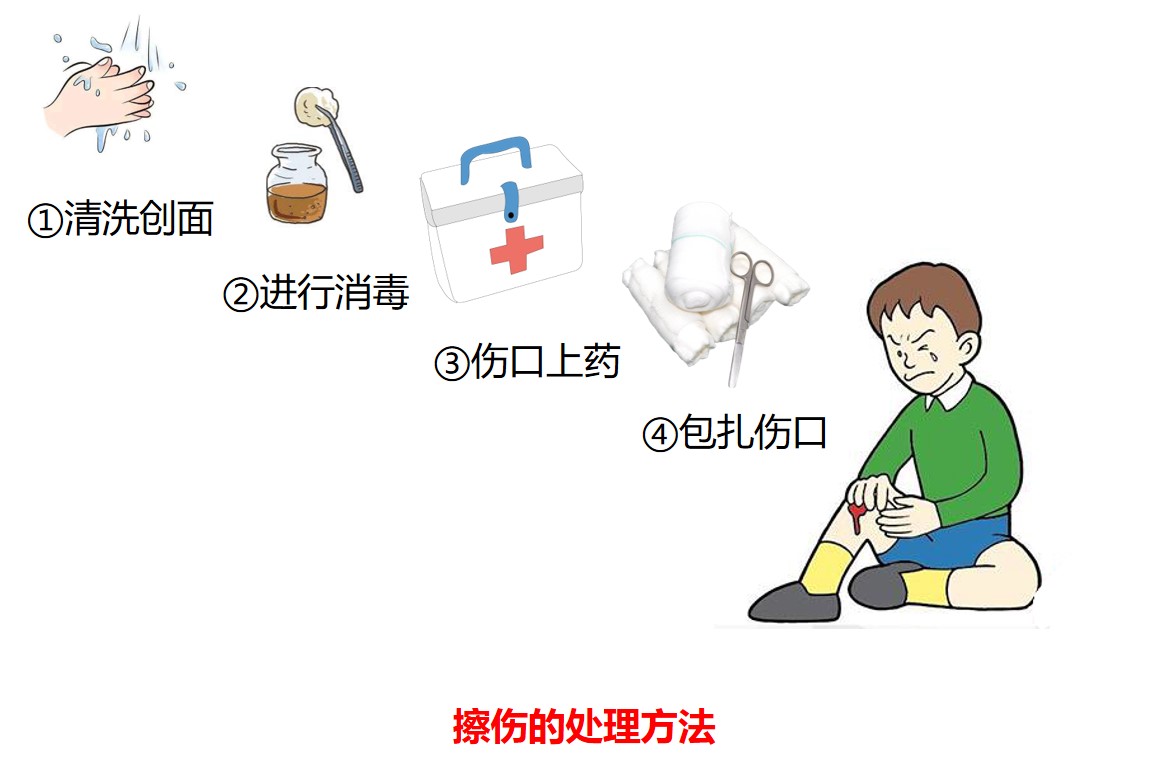 常见运动损伤及处理方法教案,怎样处理运动锻炼中常见的损伤