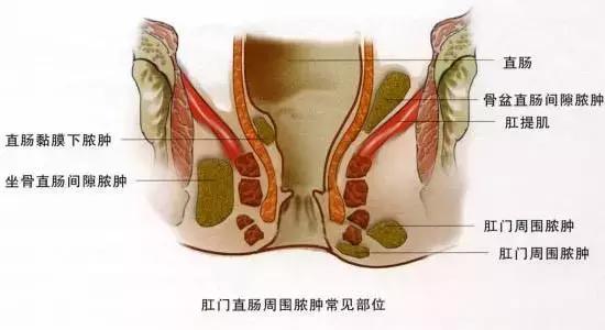 早期肛周脓肿选择口服药,肛周脓肿硬块一般多长时间能消除
