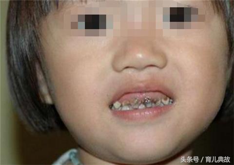 2岁宝宝牙齿龋齿很严重怎么办,大人帮着孩子刷牙还是龋齿怎么办