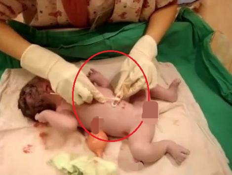 新生儿脐带被医生剪太长了怎么办,刚出生的婴儿被护士剪肚脐