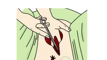 顺产时,自然撕裂、侧切哪个恢复快?有什么区别和影响