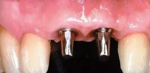 经常梦到牙齿松动脱落怎么回事,牙齿松动咬不动硬的菜怎么回事