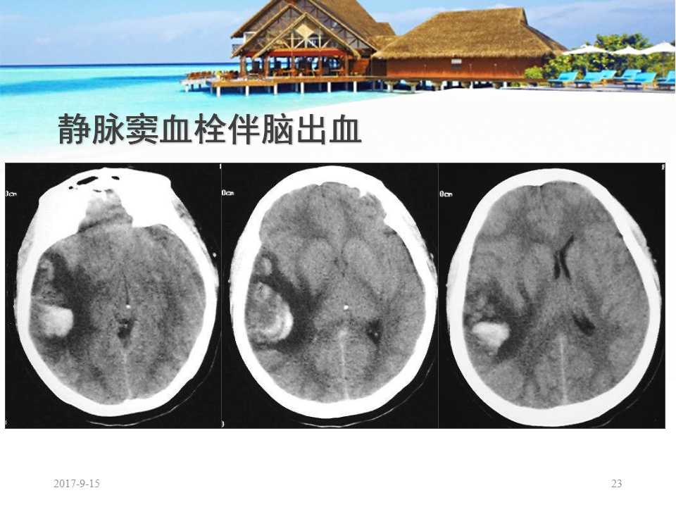 颅内静脉窦血栓形成怎么治疗,颅内静脉窦血栓怎么治疗