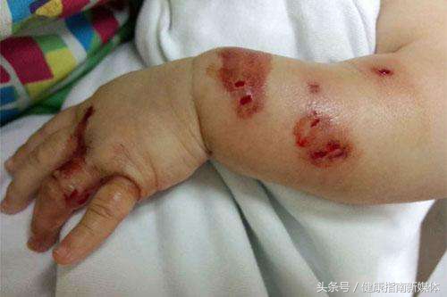 不小心踩到铁钉了怎么办,踩了锈钉子打了破伤风就没事了吗