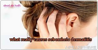 西医认为脂溢性皮炎的原因有什么,脂溢性皮炎发病年龄及发病率