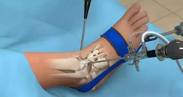 创伤性踝关节炎可能源自一次不经意的扭脚