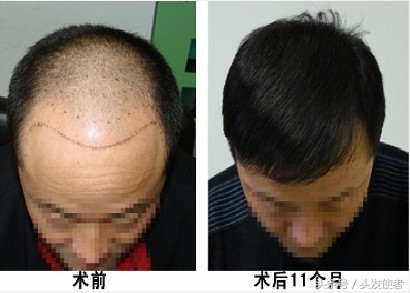 脱发发际线上扬怎么办,严重脱发秃顶发际线后移如何改善